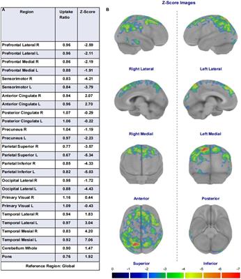 Correlation analysis between 18F-fluorodeoxyglucose positron emission tomography and cognitive function in first diagnosed Parkinson’s disease patients